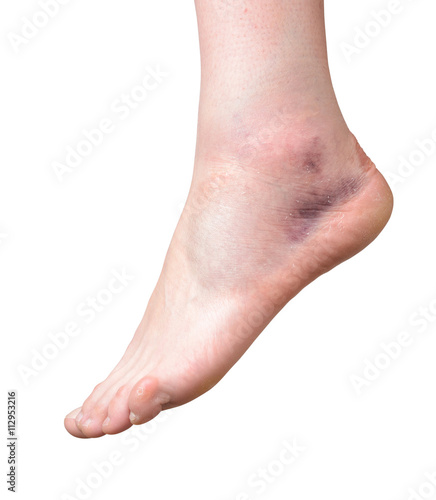 sprained ankle isolated on white