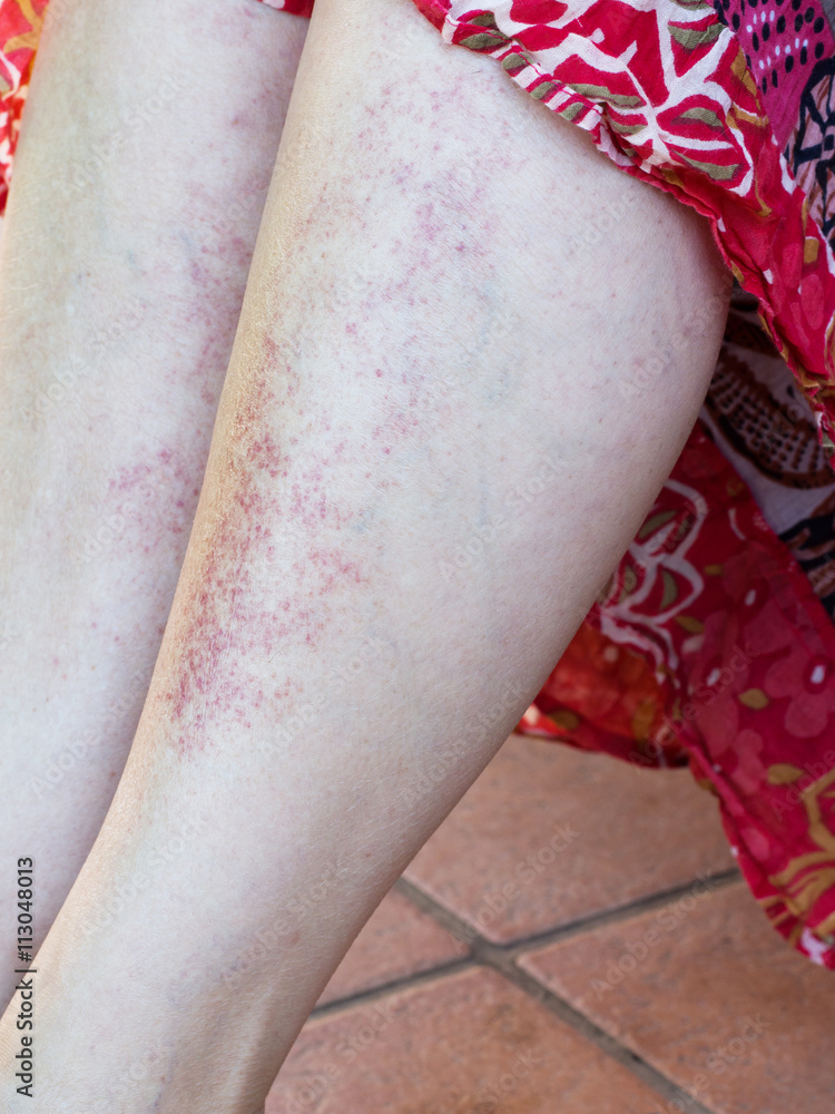 Sun adverse reaction, allergy, red rash on legs. Stock Photo Adobe Stock
