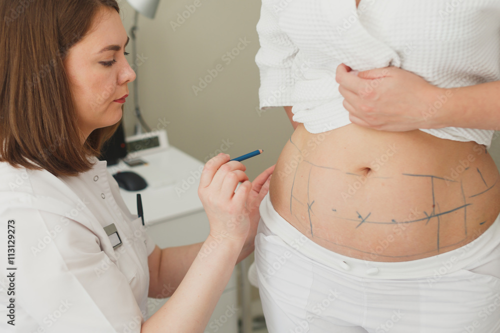 Surgeon, liposuction, body.Overweight, obesity, fat woman, fat belly, hips and excess weight. cellulite, stretching Surgeon, liposuction, body.Overweight, obesity, fat woman, fat belly, hips and excess weight. cellulite, stretching