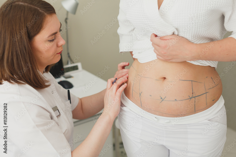 Surgeon, liposuction, body.Overweight, obesity, fat woman, fat belly, hips and excess weight. cellulite, stretching Surgeon, liposuction, body.Overweight, obesity, fat woman, fat belly, hips and excess weight. cellulite, stretching