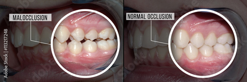 dental treatment malocclusion: before and after photo