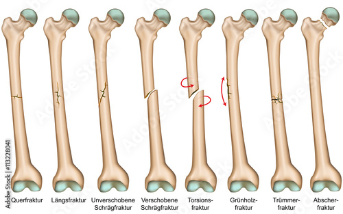 Arten von Frakturen, medical vector illustration