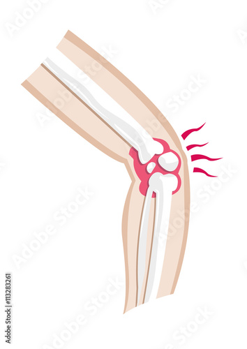 Diagram of an injured leg and joint. Isolated Editable Clip Art.
