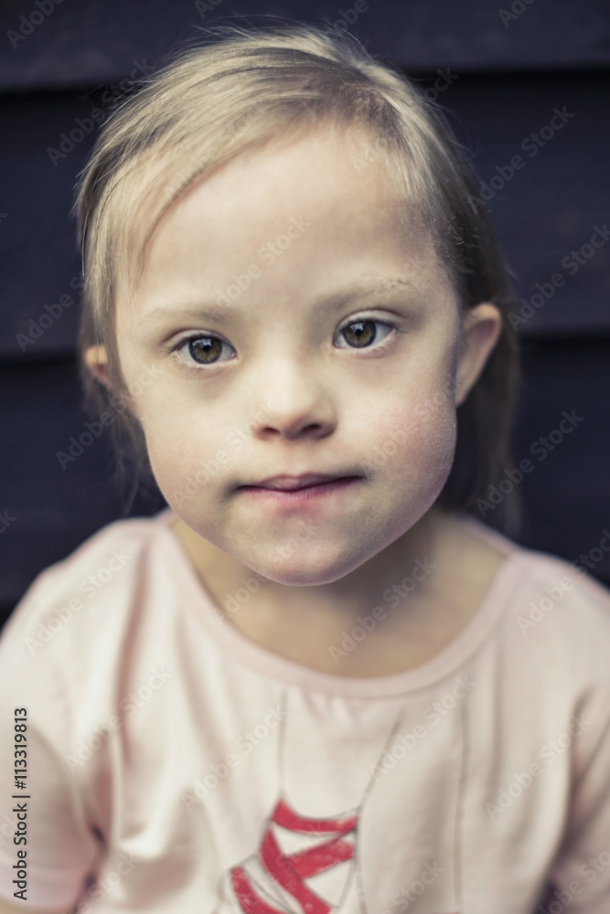 Thoughtful girl with down syndrome looking away Thoughtful girl with down syndrome looking away