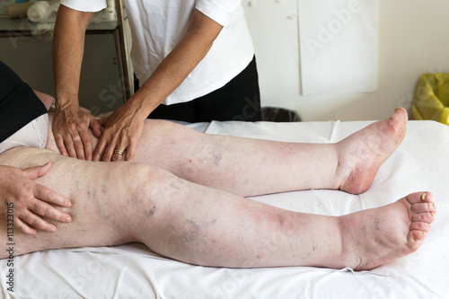 Terapista che esegue il massaggio linfodrenante  manuale su gambe con problemi di edema linfatico photo