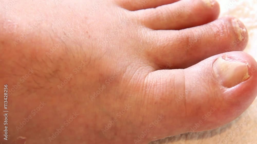 Left Leg of Elderly Man With Nail Fungus on the Toes Left Leg of Elderly Man With Nail Fungus on the Toes