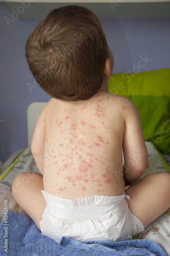 Chicken pox