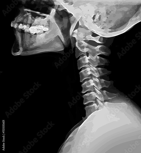 X-ray image of the cervical spine and the head, black and white