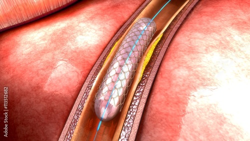 Stent photo