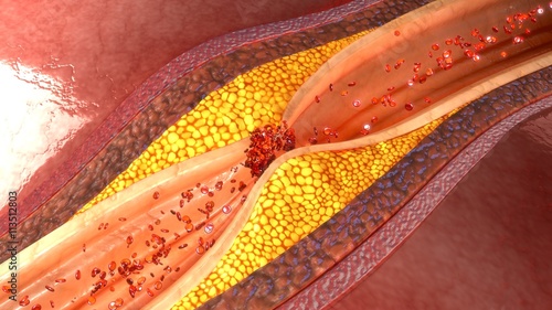Coronary artery plaque photo