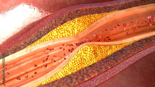 Photography Coronary artery plaque