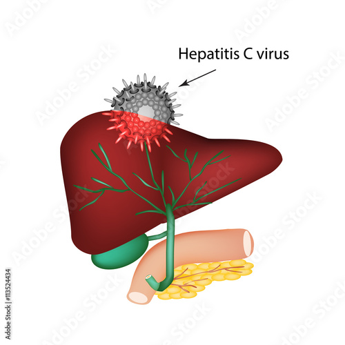 Hepatitis C. The introduction of the hepatitis C virus in the liver. The structure of the digestive system. Gallbladder. Pancreas. Bile ducts. Duodenum. World Hepatitis Day. Vector illustration 