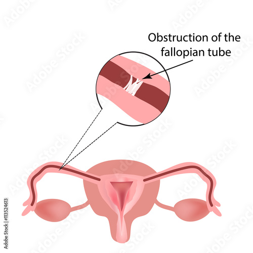 Obstruction of the fallopian tubes. The structure of the pelvic organs. Infographics. Vector illustration on isolated background