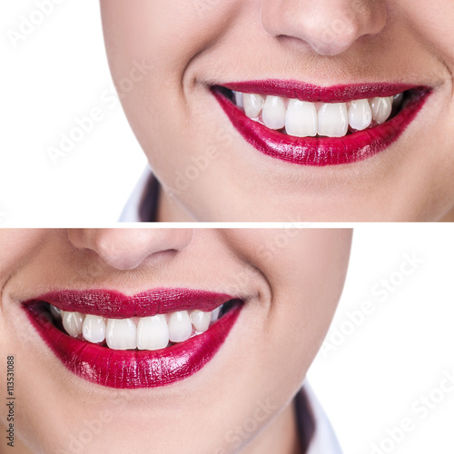 Lips before and after filler injections