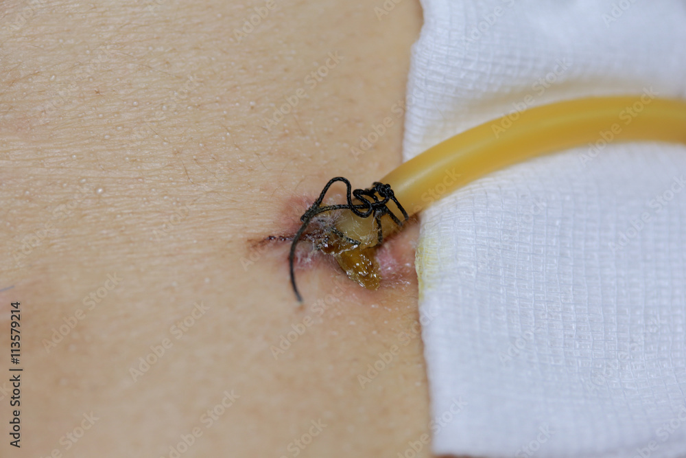 Obraz premium scar from operation with a black fiber. Stitched up skin after