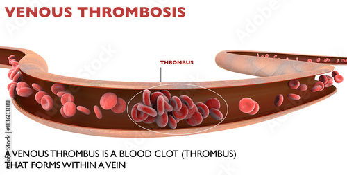 Trombosi venosa profonda, formazione di un trombo all’interno di una vena