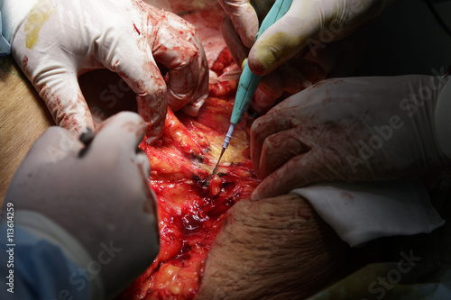 Surgeon cuts the flesh with coagulator during the surgery close-up