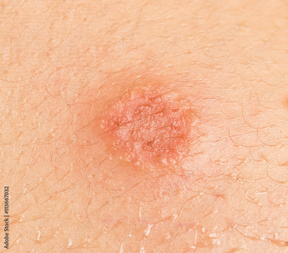 Fototapeta premium round abrasion on the skin