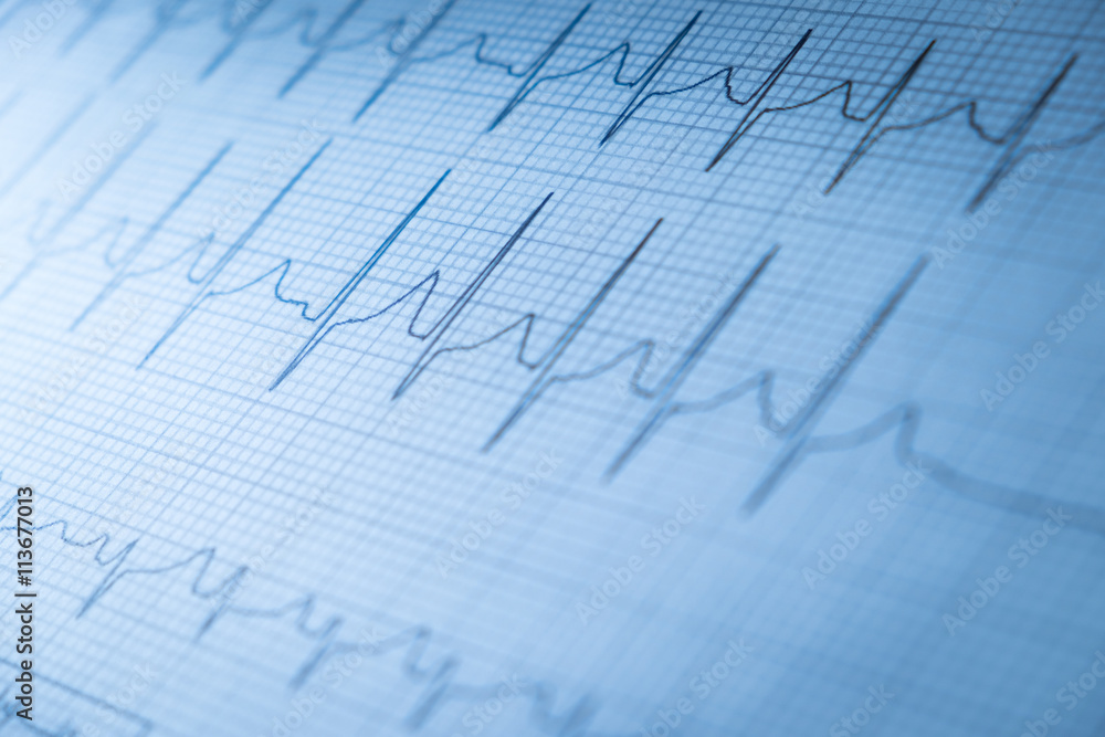 Close up of an electrocardiogram in paper form Close up of an electrocardiogram in paper form