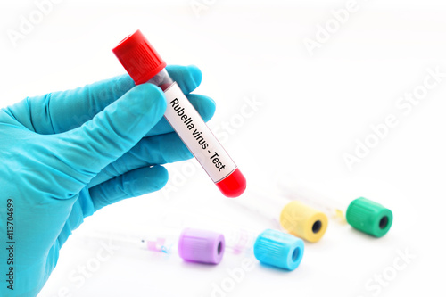 Blood sample for rubella virus test