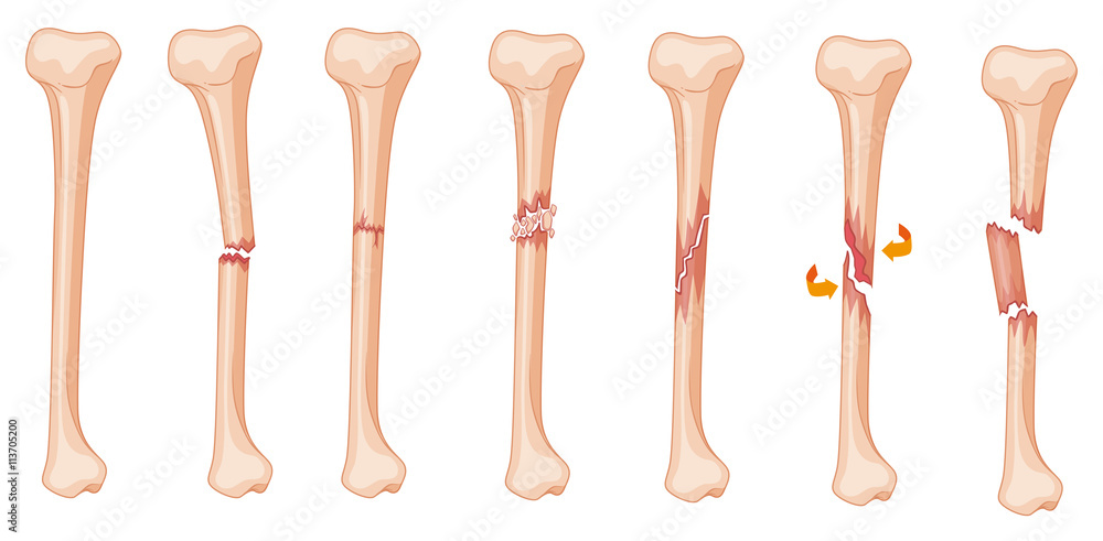 Diagram of leg fracture in different stages - obrazy, fototapety, plakaty 