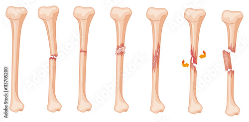 Photo Diagram of leg fracture in different stages
