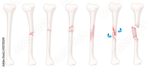 Fotografia Different stages of leg fracture