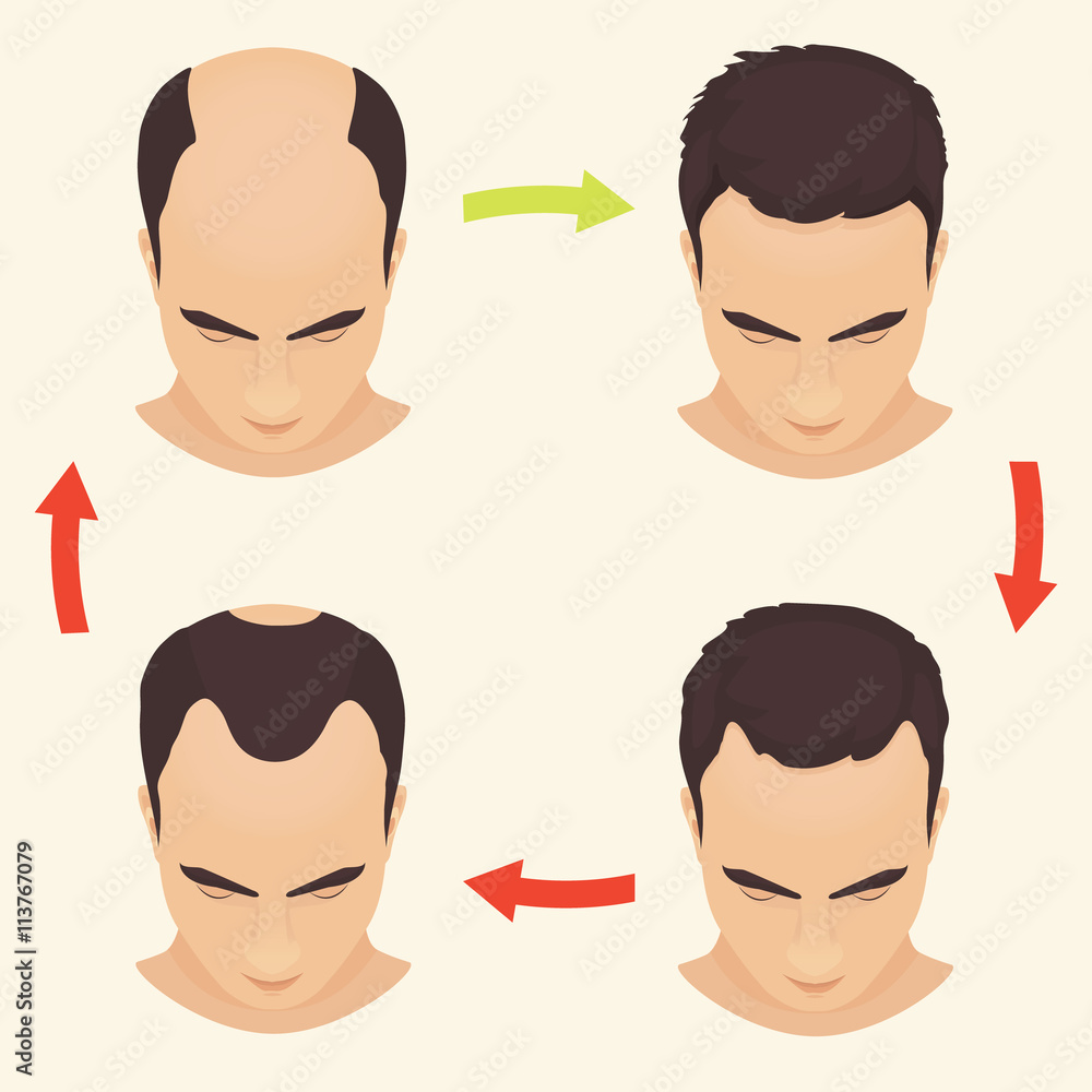 Male hair loss stages set. Man before and after hair treatment and hair  transplantation. Male pattern baldness. Transplantation of hair. Vector  illustration. Stock Vector | Adobe Stock