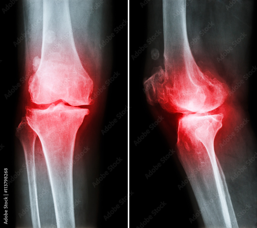 Osteoarthritis knee . film xray knee ( anterior posterior and