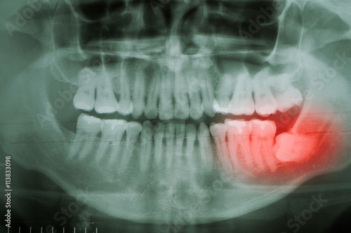 Tableau sur toile Dental X-Ray. A panoramic x-ray of a mouth, with intact wisdom t