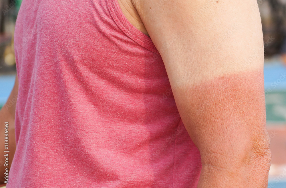 Sunburn. Asian man with massive sunburn on his arm 