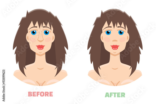 Plastic surgery, rhinoplasty before and after