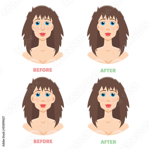 Plastic surgery, otoplasty, rhinoplasty before and after