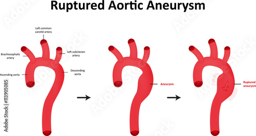 Ruptured Aortic Aneurysm Diagram