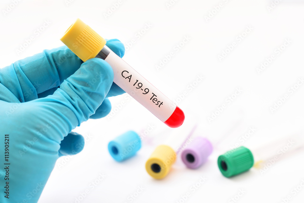 Blood sample for CA 19-9 test, pancreatic cancer diagnosis Blood sample for CA 19-9 test, pancreatic cancer diagnosis