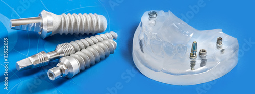 dental implants in dental model