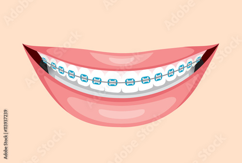Beautiful Smile With Teeth Braces, Medical, Dentistry, Hospital, Checkup, Patient, Hygiene, Healthy, Treatment