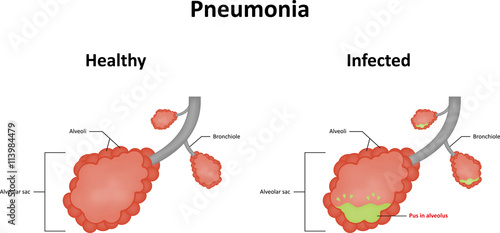 Pneumonia Alveoli