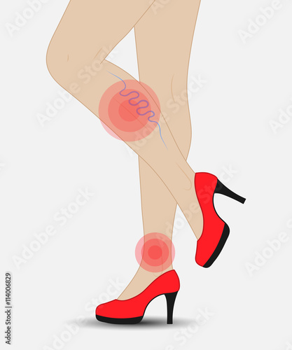 varicose