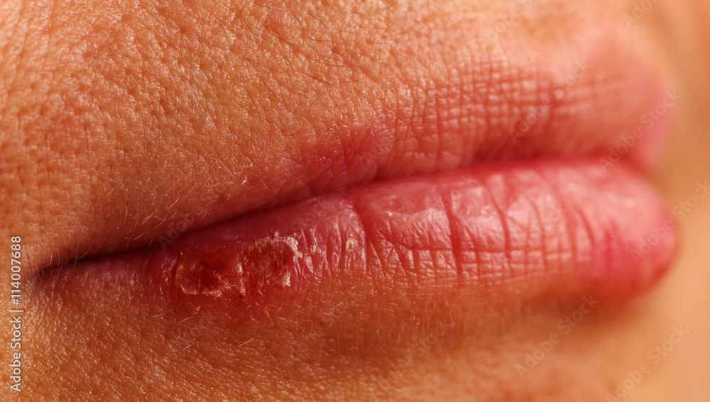 manifestation of herpes manifestation of herpes