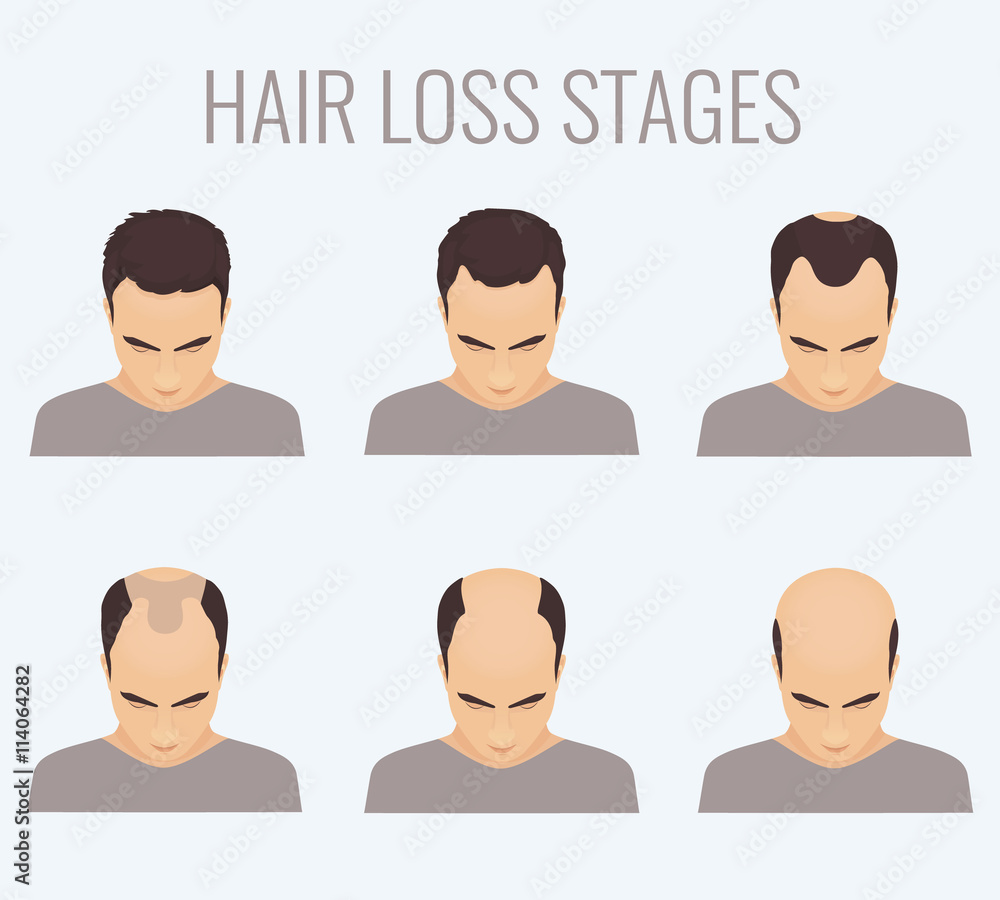 Male hair loss stages set. Top view portrait of a man losing hair. Male  pattern baldness. Transplantation of hair. Signs of balding. Frontal hair  loss. Vector illustration. Stock Vector | Adobe Stock