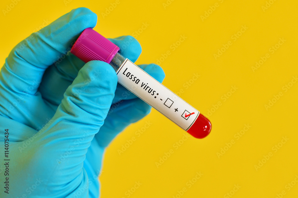 Obraz premium Blood sample positive with Lassa virus test 