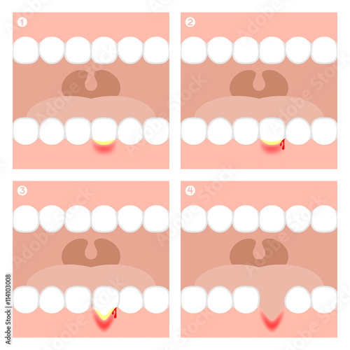 Gingivitis or Periodontitis illustration vector infographic