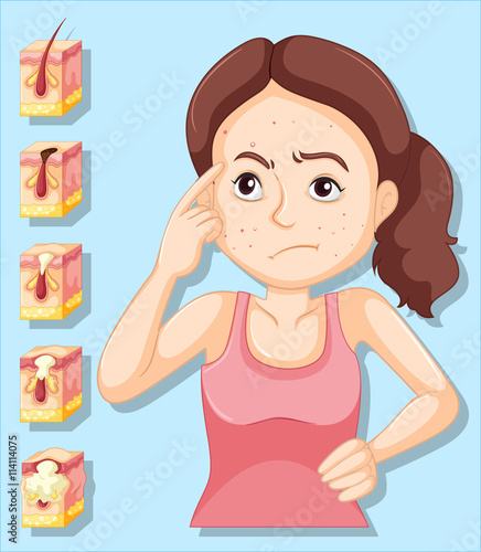 Woman and pimple problems