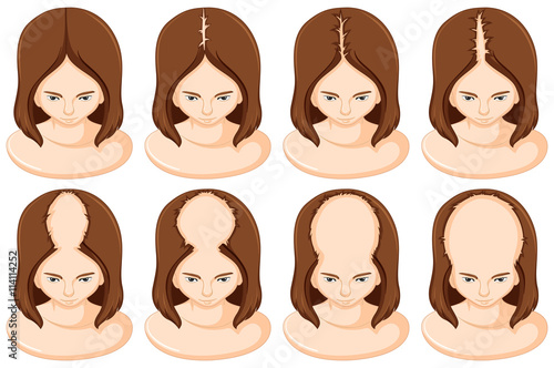Stages of hair loss in woman