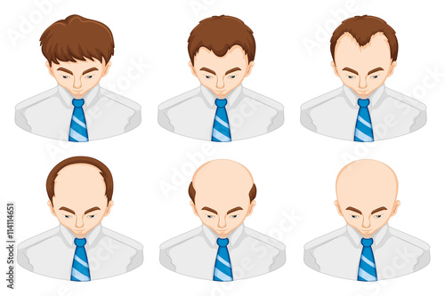 Stages of hair loss in man