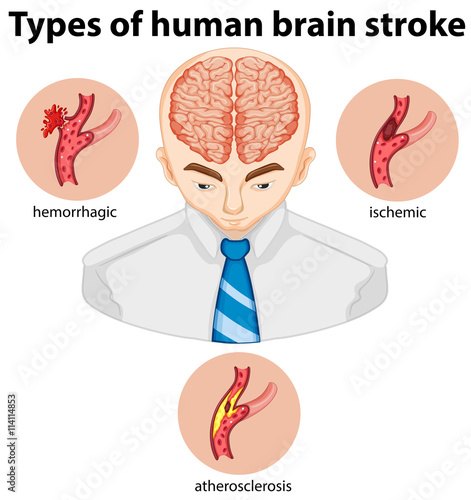 Types of human brian stroke