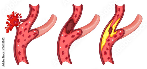 Symptoms in human vein