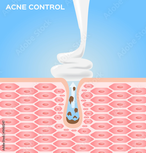 cream moose and lotion apply on skin to take out an acne . acne vector graphic