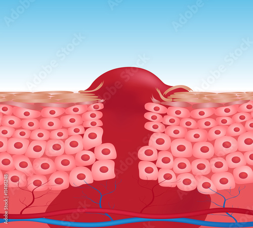 wound skin vector graphic . blood come out of wound
